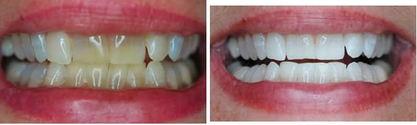 Nu Radiance Classic whitening gel - 30% (3*3мл гель для домашнего отбеливания) — изображение 2